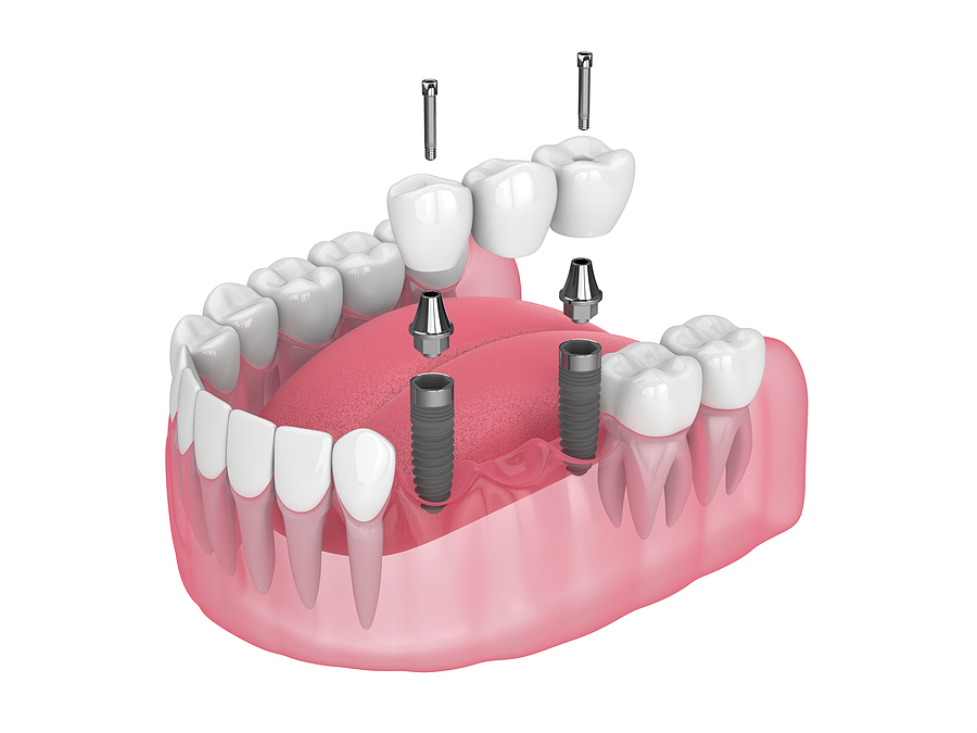 A Comprehensive Guide to Implant Restoration: Restoring Your Smile in San Jose, CA