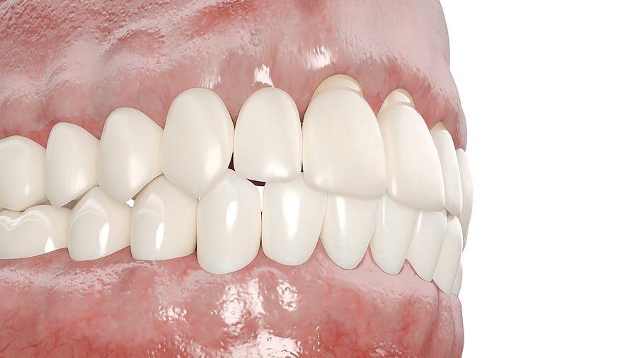A Guide to Pinhole Surgery in San Jose, CA: A Minimally Invasive Solution for Gum Recession
